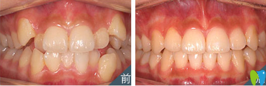 牙齒不齊矯正前后