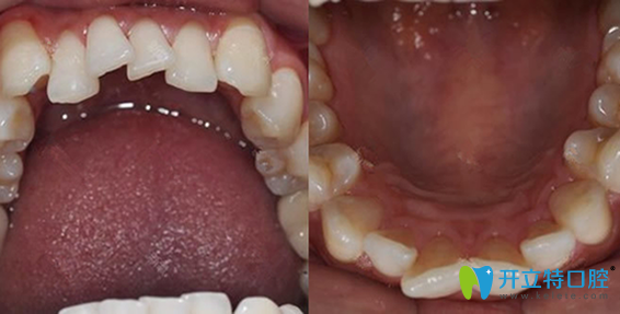 牙齒錯亂在惠州致美口腔做了隱性矯正,三個月效果就很明顯