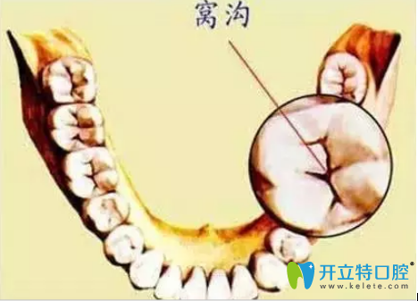 石家莊三博口腔李磊做客FM98.1廣播電臺(tái)解說窩溝封閉