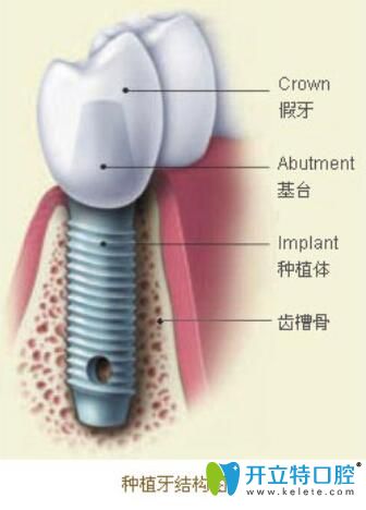 低價(jià)位的種植牙要警惕！