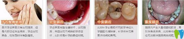 牙齒有個洞要補嗎 補牙的方式有哪些 補一顆牙價格多少錢