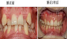 牙齒矯正多少錢?花1.6萬元在深圳美萊口腔做半隱形矯正案例