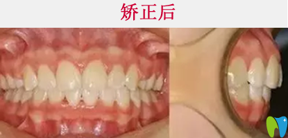 清遠(yuǎn)牙科哪家好  看中大口腔牙齒矯正真人案例效果對比