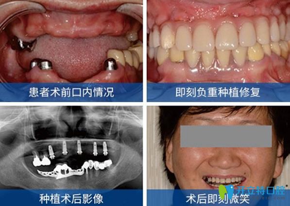 拜博口腔鄧大貴醫(yī)生全口牙缺失即刻種植效果