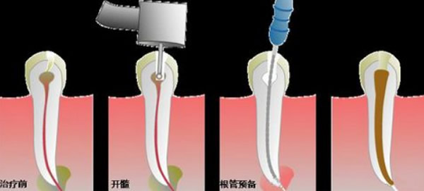 根管治療后牙疼怎么辦 看北京拜博口腔正畸醫(yī)生的解決方法