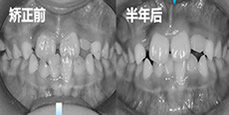 分享7歲兒子在成都金琴口腔做地包天矯正價(jià)格及真實(shí)經(jīng)歷