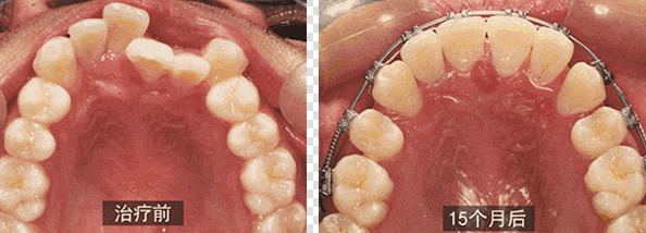 在廣州壹加壹口腔自鎖托槽矯正牙齒15個月了 舍不得拆牙套