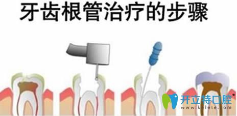 牙齒根管治療的費(fèi)用一般多少錢一顆?1500還是3000或4000元