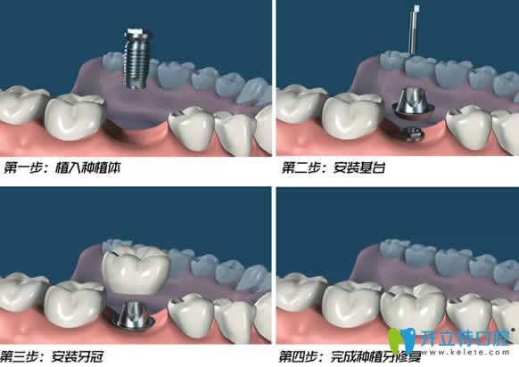 烏魯木齊凱樂口腔劉向峰介紹種植牙過程圖