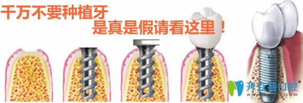 大家千萬不要種植牙 如果非常后悔做了種牙請看這里的內(nèi)幕