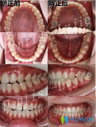 28歲顧客矯正牙齒前后對比照
