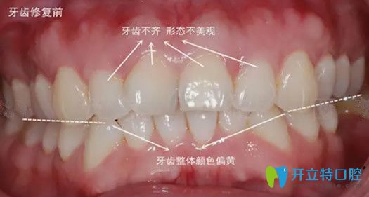 在嘉興曙光口腔做牙齒美容修復(fù)前