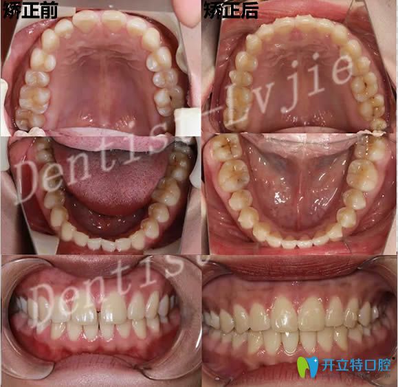 北京圣貝口腔劉雪蓮牙齒矯正前后對比照