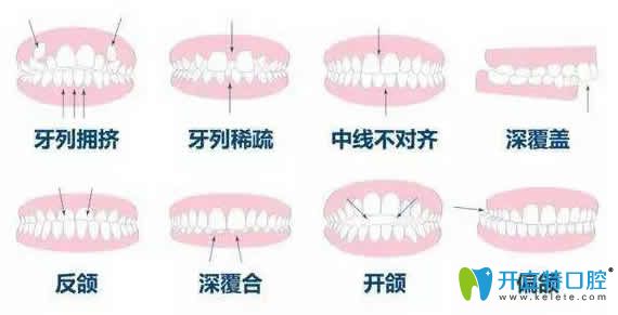 兒童牙齒矯正年齡