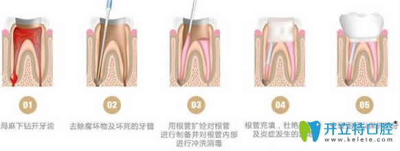 烏魯木齊凱樂口腔姚歡吉醫(yī)生根管治療步驟圖