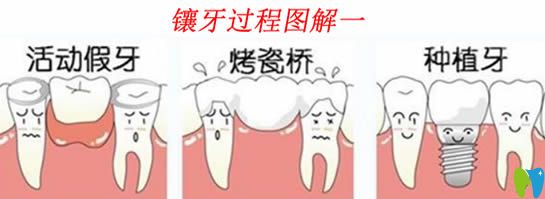 鑲牙疼嗎?是怎么鑲的?看完內(nèi)附的鑲牙過程圖解你就明白了