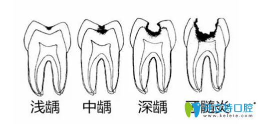 牙壞了一半爛掉了，這樣的蟲牙是補好還是拔好？