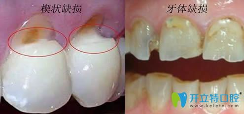 楔狀缺損屬于牙體缺損嗎？聽說楔狀缺損不要盲目補牙