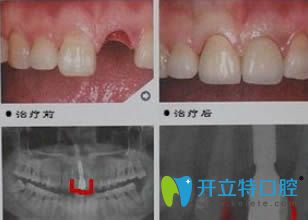 杭州植得口腔單顆牙種植效果對比圖