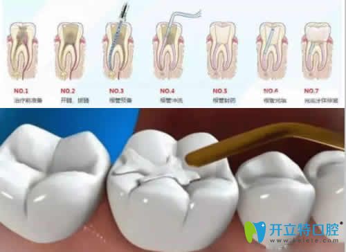 武漢優(yōu)益佳口腔潘斌醫(yī)生介紹根管治療步驟