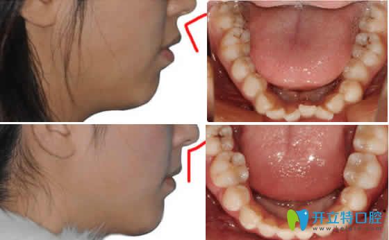 武漢優(yōu)益佳口腔楊高強(qiáng)隱形矯正案例效果圖