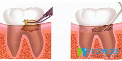 洗牙和齦下刮治可以一起做嗎？看洗牙和刮治的區(qū)別在哪里