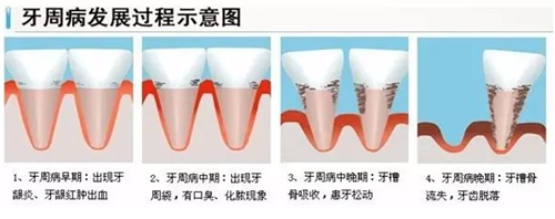 整牙會導致牙齦萎縮嗎？整牙后牙齦萎縮怎么辦？