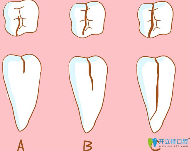 才22歲牙齒就隱裂了，深究牙齒開裂是什么原因造成的？