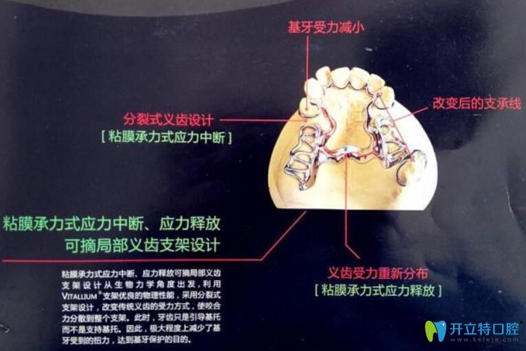 維他靈支架的優(yōu)缺點公布，它和純鈦支架相比好的竟然是…