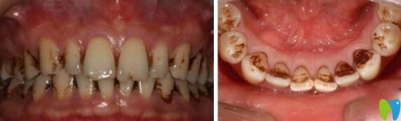  求助!牙齒煙斑怎么去除,單洗牙能去掉嗎？
