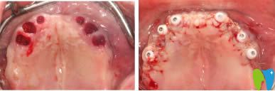 重慶齊美口腔即刻種植牙術(shù)后即刻效果