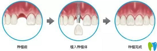 清遠(yuǎn)中大口腔曹銀光科普即刻種植牙技術(shù)優(yōu)勢