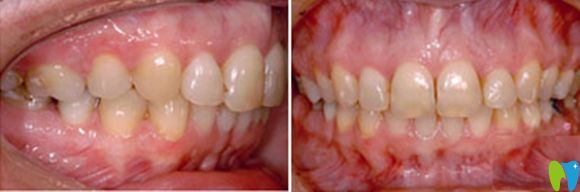 西安中諾口腔突嘴齙牙齒矯正術(shù)后效果圖