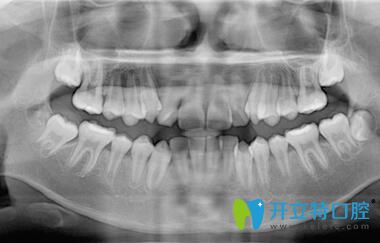 我在深圳正夫口腔做牙齒矯正前拍片