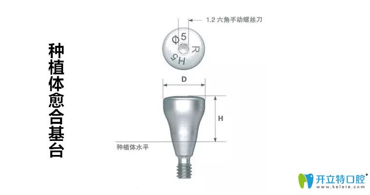 種牙前建議先弄清楚種植牙愈合基臺是什么以及它的作用