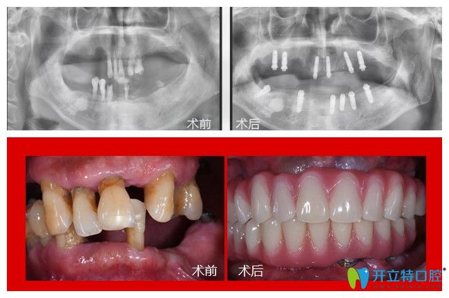 廣州廣大口腔75歲郭老在廣州廣大口腔做了全口種植牙1年多后來反饋感受