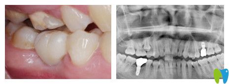 華美口腔做的雙側(cè)后牙缺失的案例圖