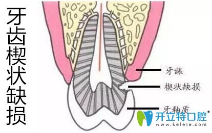 牙齒楔狀缺損千萬不要盲目補牙,先弄清楔狀缺損的修復(fù)方法