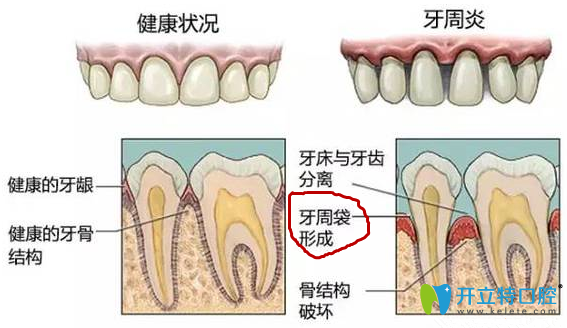 牙周袋怎么治療?收下這份深度三級(jí)分類(lèi)療法大全及圖片