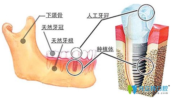 缺牙后做種植牙好還是智齒前移好呢—西安中諾口腔來支招