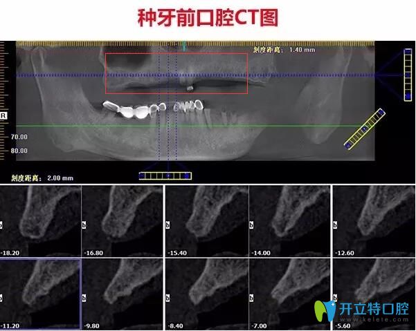 不了解珠海種牙哪家醫(yī)院好，不如看看仁愛口腔即刻種植牙