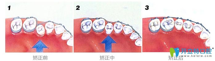 童美齒科兒童矯正牙齒過程