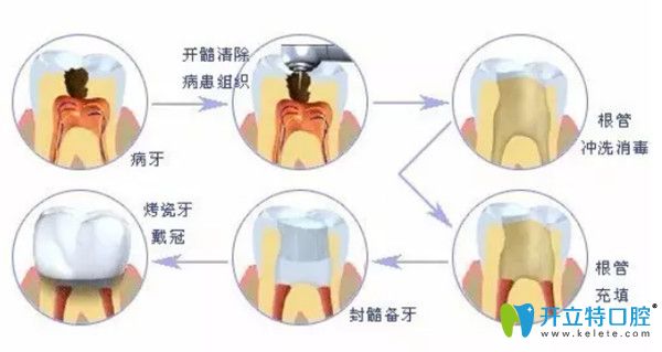 根管治療的步驟