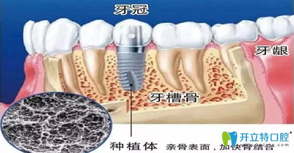 種植牙要如何護(hù)理才能用的更久