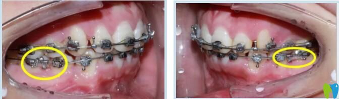 金屬托槽矯正案例 惠州致美口腔