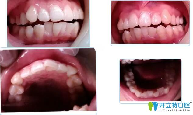 惠州致美口腔金屬矯正案例