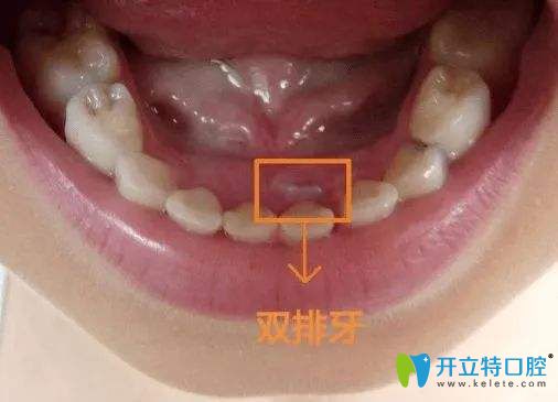 孩子長出雙排牙只因?yàn)槁槁榉噶艘粋€錯誤你敢信？