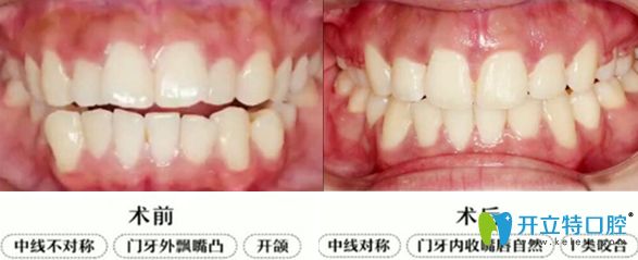 上排門(mén)牙外凸開(kāi)頜隱適美牙套矯正2年畢業(yè)啦,大波對(duì)比圖來(lái)襲