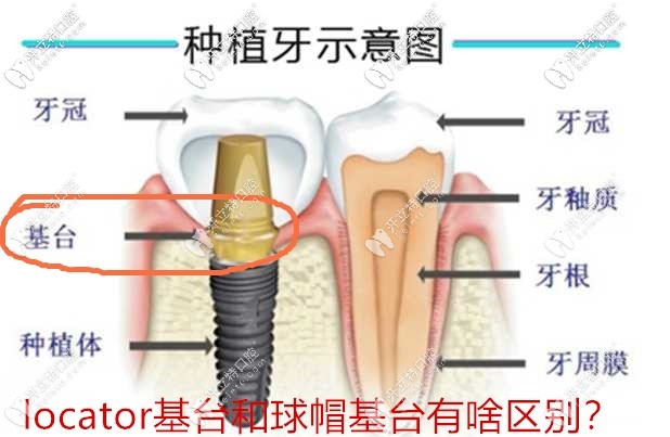 看這簡單的幾張圖就能明白locator基臺(tái)和球帽基臺(tái)的區(qū)別