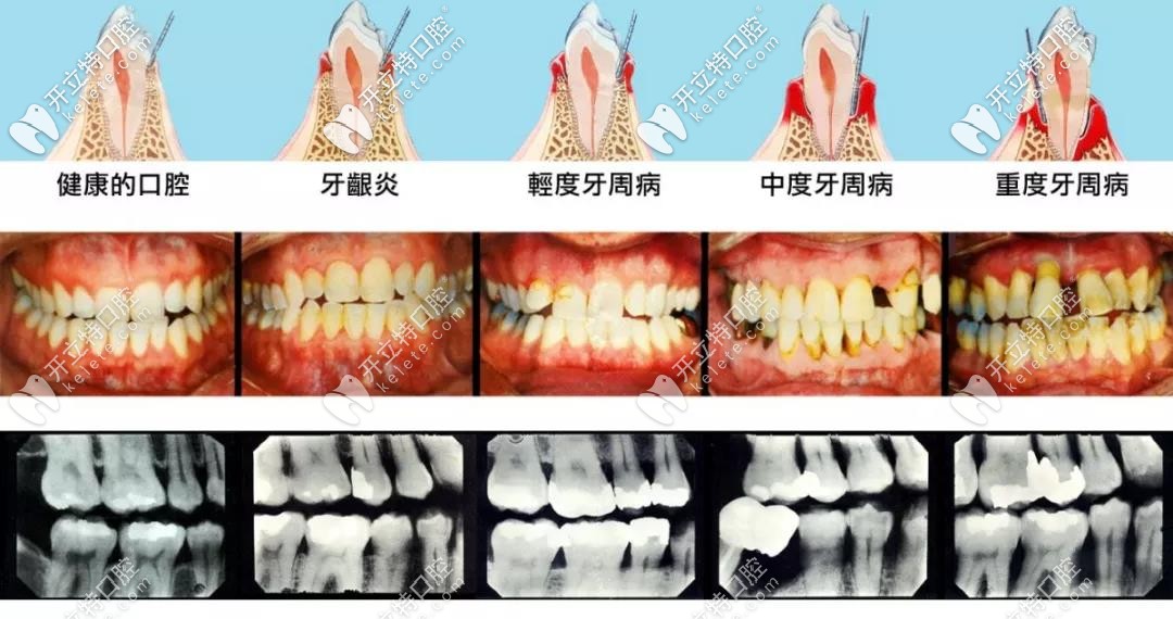 齲齒牙周炎一定要盡早治療